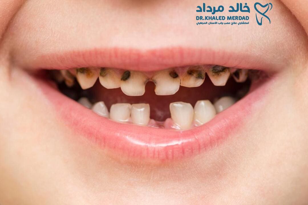 اسباب تسوس اسنان الاطفال