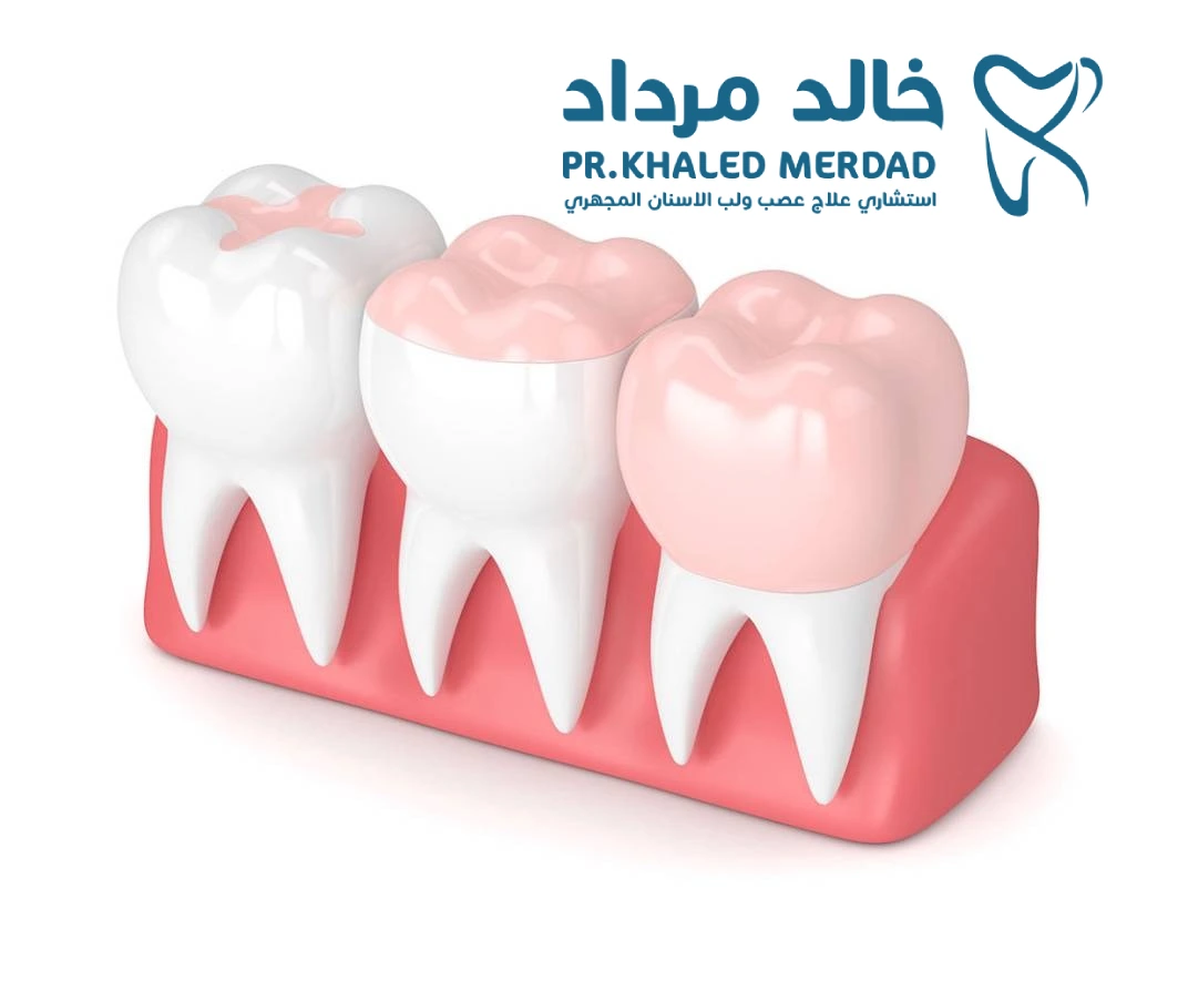 انواع حشوات الأسنان