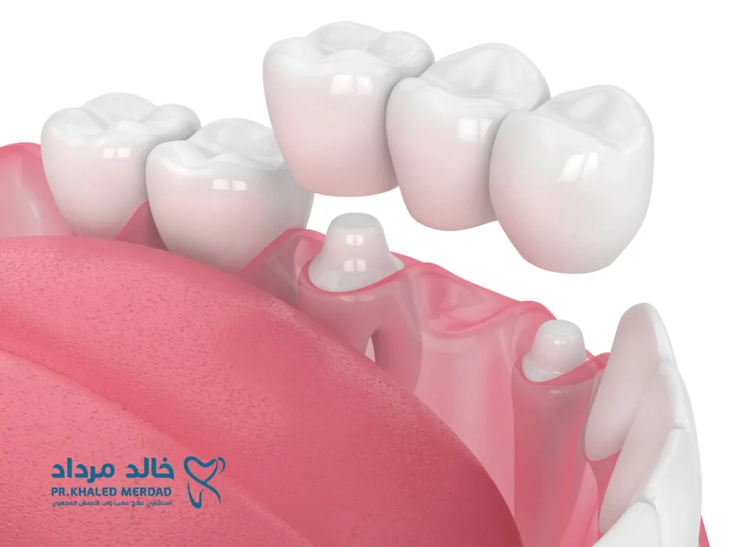 بدائل زراعة الأسنان